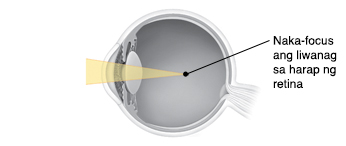 Cross section ng mata na ipinakikita ang liwanag na nagfo-focus sa harap ng retina.