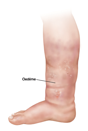 Oedème