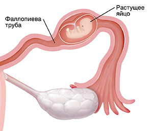 Поперечный срез маточной трубы, когда эмбрион растет при внематочной беременности: крупный план.