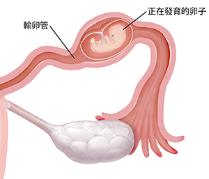 在宮外孕的情況下,有胚胎在裡面發育的輸卵管放大剖面圖。