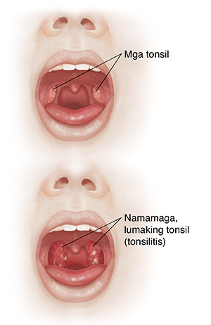 Harap na kuha ng mukha na may nakabukas na bibig na ikinukumpara ang oral cavity at mga tonsil na may namamagang lalamunan at lumaking mga tonsil.