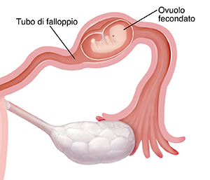 Primo piano della sezione trasversale della tuba di Falloppio con un embrione che cresce all'interno in gravidanza ectopica.