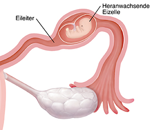 Vergrößerte Darstellung eines Querschnitts einer Eileiterschwangerschaft, bei der ein Embryo im Eileiter heranwächst.