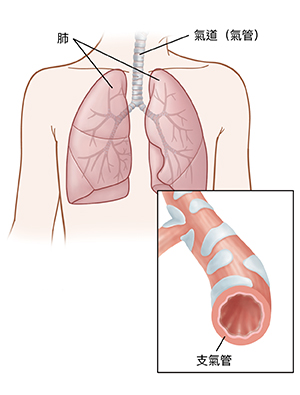 顯示肺部的兒童胸部前視圖。插圖顯示支氣管的橫截面。
