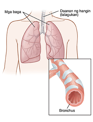 Harapang kuha ng dibdib ng bata na ipinakikita ang mga baga. Nakasingit na larawan na nagpapakita ng cross section ng bronchus.