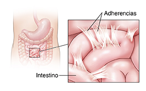 Vista anterior del abdomen de un niño donde se observan el estómago y los intestinos. El recuadro muestra las adherencias.