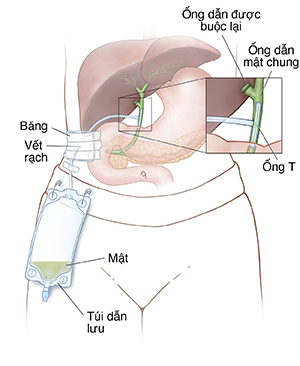 Ống thông nằm ngoài.
