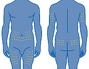 Injection sites.